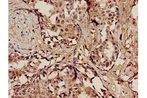 Immunohistochemistry analysis of human breast cancer using ABIN7150239 at dilution of 1:100 (POLE Antikörper  (Catalytic Subunit A))