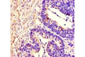 Immunohistochemistry of paraffin-embedded human ovarian cancer using ABIN7167518 at dilution of 1:100