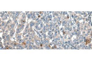 Immunohistochemistry of paraffin-embedded Human liver cancer tissue using CAPN3 Polyclonal Antibody at dilution of 1:30(x200) (Calpain 3 Antikörper)