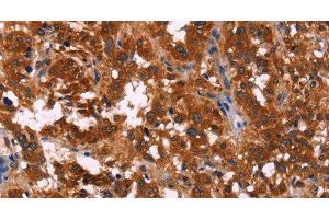 Immunohistochemistry of paraffin-embedded Human thyroid cancer using RPSA Polyclonal Antibody at dilution of 1:60 (RPSA/Laminin Receptor Antikörper)