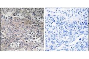 Immunohistochemistry analysis of paraffin-embedded human breast carcinoma tissue, using TUFM Antibody.