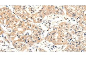 Immunohistochemistry of paraffin-embedded Human lung cancer tissue using SLC27A1 Polyclonal Antibody at dilution 1:40 (SLC27A1 Antikörper)