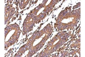 IHC-P Image Immunohistochemical analysis of paraffin-embedded human colon carcinoma, using Galectin 1, antibody at 1:500 dilution. (LGALS1/Galectin 1 Antikörper)