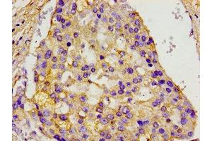 Immunohistochemistry of paraffin-embedded human breast cancer using ABIN7153843 at dilution of 1:100 (GANP Antikörper  (AA 292-435))
