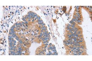 Immunohistochemistry of paraffin-embedded Human colon cancer using CD327 Polyclonal Antibody at dilution of 1:70 (SIGLEC6 Antikörper)