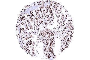 Ovarian clear cell carcinoma with strong Cyclin E1 staining of all tumor cells (Rekombinanter Cyclin E1 Antikörper)