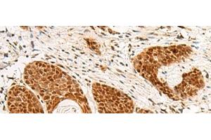 Immunohistochemistry of paraffin-embedded Human esophagus cancer tissue using POM121 Polyclonal Antibody at dilution of 1:75(x200) (POM121 Antikörper)