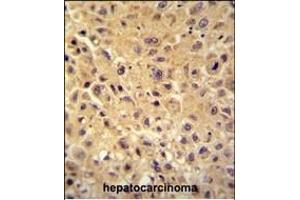 WBSCR27 antibody (N-term) (ABIN654505 and ABIN2844234) immunohistochemistry analysis in formalin fixed and paraffin embedded human hepatocarcinoma followed by peroxidase conjugation of the secondary antibody and DAB staining. (WBSCR27 Antikörper  (N-Term))