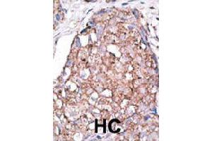 Formalin-fixed and paraffin-embedded human hepatocellular carcinoma tissue reacted with SIGLEC7 polyclonal antibody  , which was peroxidase-conjugated to the secondary antibody, followed by AEC staining. (SIGLEC7 Antikörper  (C-Term))