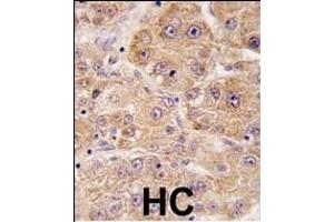 Formalin-fixed and paraffin-embedded human hepatocarcinoma tissue reacted with hUVRAG (C-term), which was peroxidase-conjugated to the secondary antibody, followed by DAB staining. (UVRAG Antikörper  (C-Term))