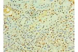 Immunohistochemistry of paraffin-embedded human breast cancer using ABIN7158358 at dilution of 1:100 (LIMK2 Antikörper  (AA 1-240))