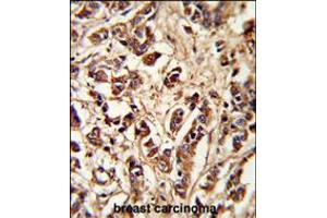Formalin-fixed and paraffin-embedded human breast carcinoma reacted with PCM-1 Antibody , which was peroxidase-conjugated to the secondary antibody, followed by DAB staining. (PCM1 Antikörper  (AA 632-661))