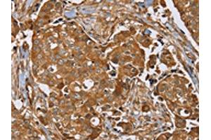 The image on the left is immunohistochemistry of paraffin-embedded Human breast cancer tissue using ABIN7192090(RAB14 Antibody) at dilution 1/40, on the right is treated with synthetic peptide. (RAB14 Antikörper)