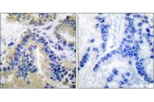 Immunohistochemistry analysis of paraffin-embedded human lung carcinoma tissue, using Caspase 10 Antibody. (Caspase 10 Antikörper  (AA 430-479))