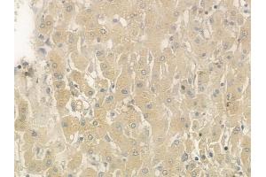 ABIN6265547 and ABIN6276370 at 1/100 staining human hepatocellular carcinoma by IHC-P. (TGFA Antikörper  (C-Term))