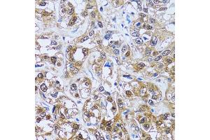 Immunohistochemistry of paraffin-embedded human liver cancer using IMPA1 antibody (ABIN5973786) at dilution of 1/100 (40x lens). (IMPA1 Antikörper)