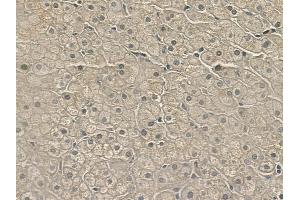 ABIN6258489 and ABIN6275819 at 1/100 staining human cervical carcinoma by IHC-P.