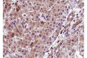 ABIN6277783 at 1/100 staining human liver carcinoma tissue sections by IHC-P. (PERK Antikörper  (pThr982))