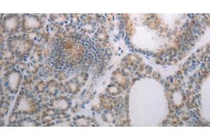 Immunohistochemistry of paraffin-embedded Human thyroid cancer using RBMS3 Polyclonal Antibody at dilution of 1:70 (RBMS3 Antikörper)