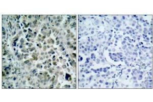 Immunohistochemical analysis of paraffin- embedded human lung carcinoma tissue, using HDAC8 (Ab-39) antibody (E021143). (HDAC8 Antikörper)