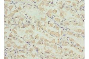 Immunohistochemistry of paraffin-embedded human gastric cancer using ABIN7164276 at dilution of 1:100 (PRICKLE2 Antikörper  (AA 615-844))