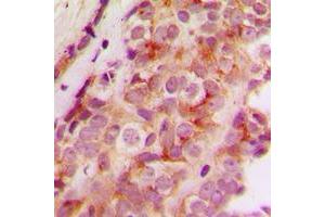 Immunohistochemical analysis of JMY staining in human breast cancer formalin fixed paraffin embedded tissue section.