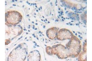 Detection of REG1b in Human Stomach cancer Tissue using Polyclonal Antibody to Regenerating Islet Derived Protein 1 Beta (REG1b) (REG1B Antikörper  (AA 23-166))