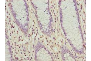 Immunohistochemistry of paraffin-embedded human colon cancer using ABIN7176680 at dilution of 1:100 (SLC3A6 (AA 246-461) Antikörper)