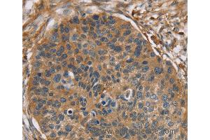 Immunohistochemistry of Human breast cancer using RIPK4 Polyclonal Antibody at dilution of 1:40 (RIPK4 Antikörper)