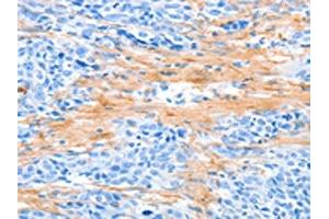 The image on the left is immunohistochemistry of paraffin-embedded Human esophagus cancer tissue using ABIN7189570(AARS Antibody) at dilution 1/50, on the right is treated with synthetic peptide. (AARS Antikörper)