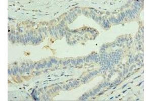 Immunohistochemistry of paraffin-embedded human breast cancer using ABIN7158044 at dilution of 1: 100 (LGI1 Antikörper  (AA 35-285))