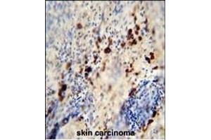 LCE1A antibody (C-term) (ABIN654845 and ABIN2844511) immunohistochemistry analysis in formalin fixed and paraffin embedded human skin carcinoma followed by peroxidase conjugation of the secondary antibody and DAB staining. (LCE1A Antikörper  (C-Term))