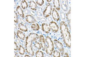 Immunohistochemistry of paraffin-embedded human liver cancer using  Rabbit pAb (ABIN6131168, ABIN6136442, ABIN6136443 and ABIN6224114) at dilution of 1:25 (40x lens). (ACOX1 Antikörper  (AA 1-270))