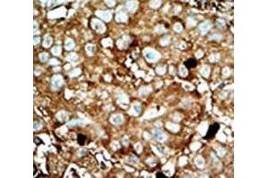 IHC analysis of FFPE human hepatocarcinoma tissue stained with the PFKFB3 antibody (PFKFB3 Antikörper  (AA 454-484))