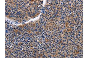 The image on the left is immunohistochemistry of paraffin-embedded Human liver cancer tissue using ABIN7129821(IGSF10 Antibody) at dilution 1/50, on the right is treated with fusion protein. (IGSF1 Antikörper)