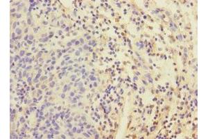 Immunohistochemistry of paraffin-embedded human bladder cancer using ABIN7152192 at dilution of 1:100 (EIF4E2 Antikörper  (AA 1-240))