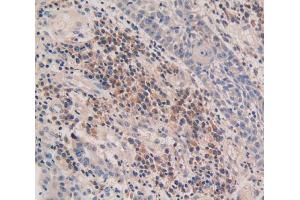 IHC-P analysis of skin cancer tissue, with DAB staining. (CASP5 Antikörper  (AA 145-327))