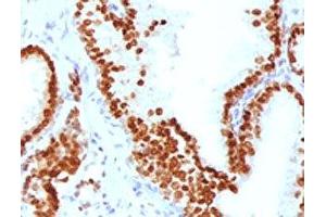 IHC testing of FFPE human prostate carcinoma with FOXA1 antibody.