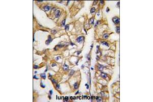 Formalin-fixed and paraffin-embedded human lung carcinoma tissue reacted with HDBP1 Antibody , which was peroxidase-conjugated to the secondary antibody, followed by DAB staining. (SLC2A4RG Antikörper  (AA 213-242))