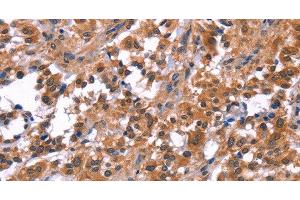 Immunohistochemistry of paraffin-embedded Human thyroid cancer tissue using PIP5K1B Polyclonal Antibody at dilution 1:30 (PIP5K1B Antikörper)