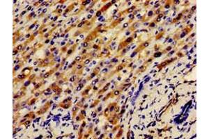 Immunohistochemistry of paraffin-embedded human liver cancer using ABIN7145416 at dilution of 1:100