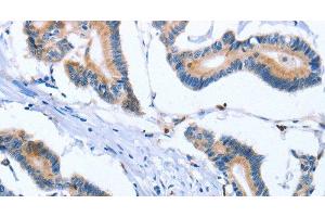 Immunohistochemistry of paraffin-embedded Human colon cancer tissue using FNK Polyclonal Antibody at dilution 1:30 (PLK3 Antikörper)