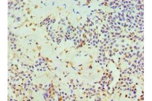 Immunohistochemistry of paraffin-embedded human breast cancer using ABIN7162382 at dilution of 1:100