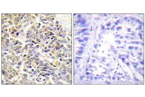 Immunohistochemistry analysis of paraffin-embedded human lung carcinoma tissue using ASC antibody. (STS Antikörper  (N-Term))
