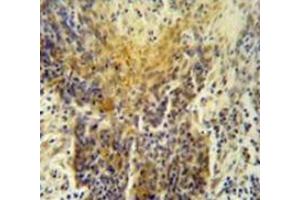 Immunohistochemistry analysis in human lung carcinoma (Formalin-fixed, Paraffin-embedded), using MRPS24 Antibody , followed by peroxidase conjugation of the secondary antibody and DAB staining.