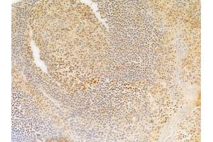 ABIN7095311 and ABIN7099368 at 1/100 staining human tongue carcinoma by IHC-P. (SOHLH2 Antikörper)