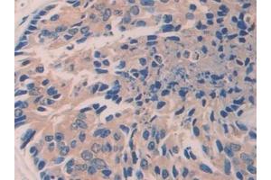 Detection of ITGb1 in Human Prostate cancer Tissue using Polyclonal Antibody to Integrin Beta 1 (ITGb1)