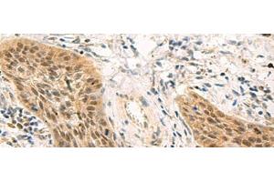 Immunohistochemistry of paraffin-embedded Human esophagus cancer tissue using PSME1 Polyclonal Antibody at dilution of 1:50(x200) (PSME1 Antikörper)