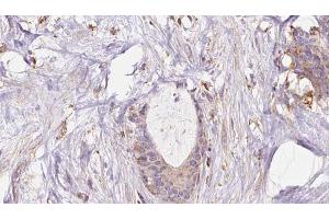 ABIN6273045 at 1/100 staining Human liver cancer tissue by IHC-P. (EXOC1 Antikörper  (N-Term))