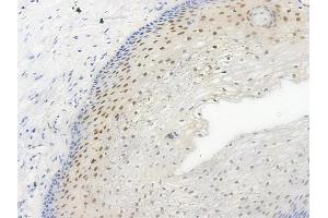 ABIN6256557 and ABIN6267446 at 1/100 staining human cervical carcinoma by IHC-P.